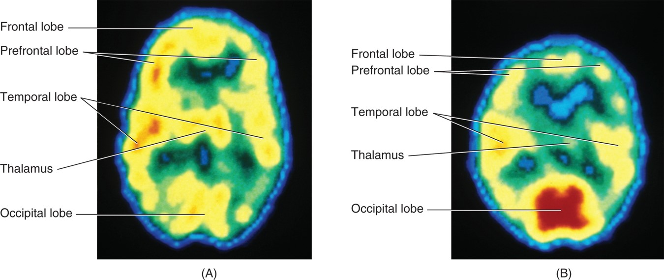 (A) PET scan of a healthy patient. (B) PET scan of a patient with schizophrenia. This patient will ...