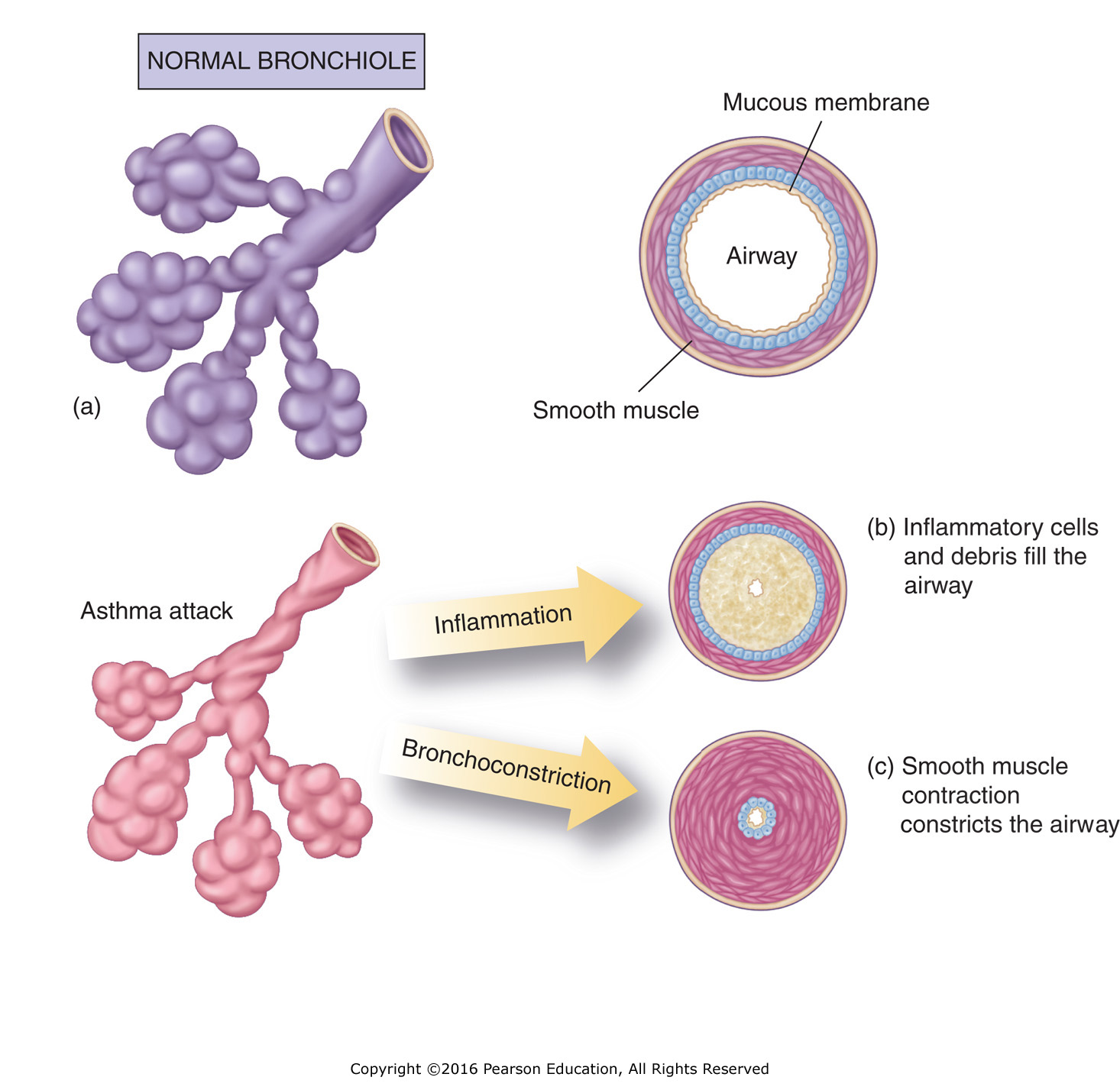 Changes in the bronchioles during an asthma attack: (a) Normal bronchiole. (b) The inflammatory ...