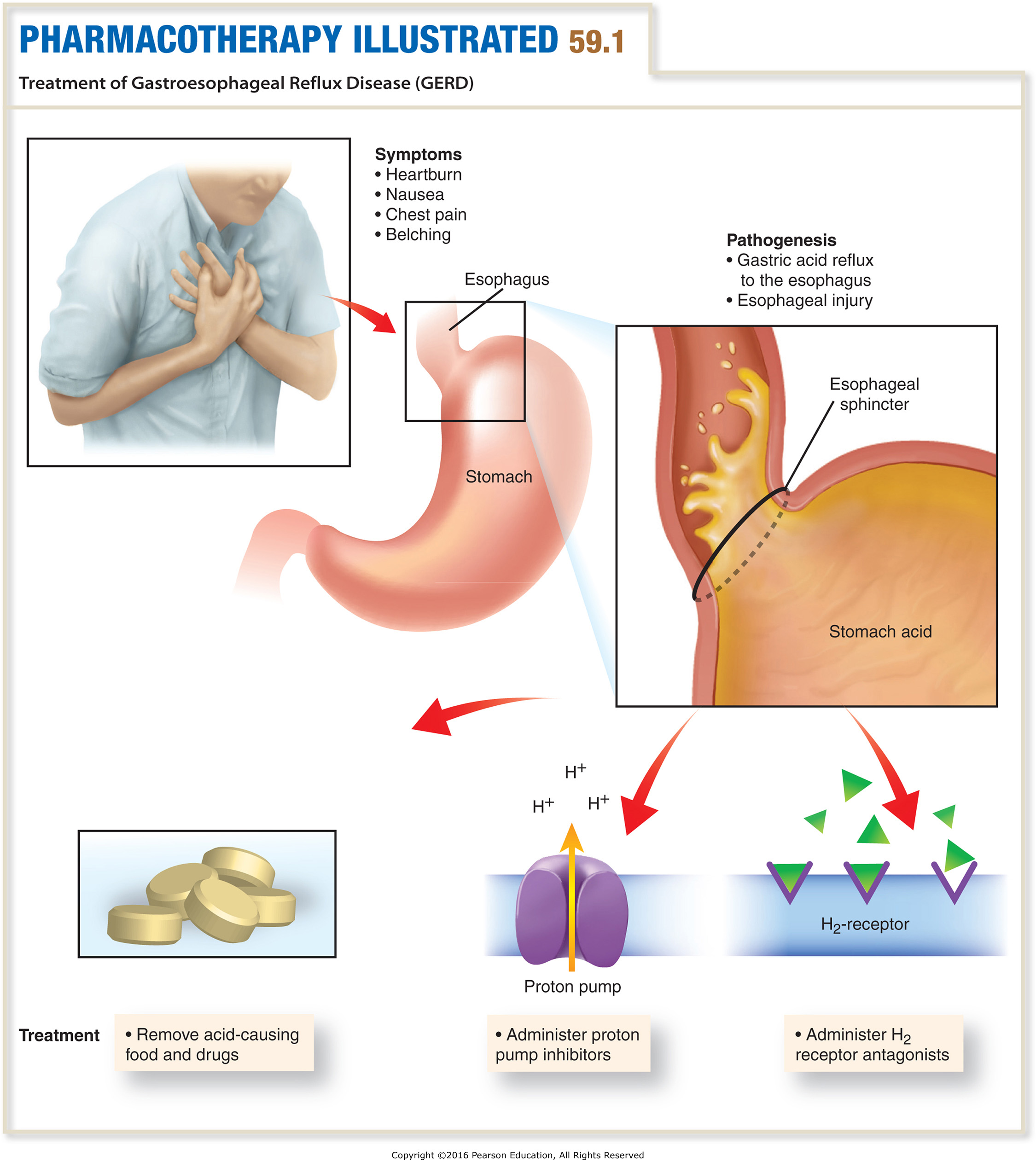 Treatment of Gastroesophageal Reflux Disease (GERD)