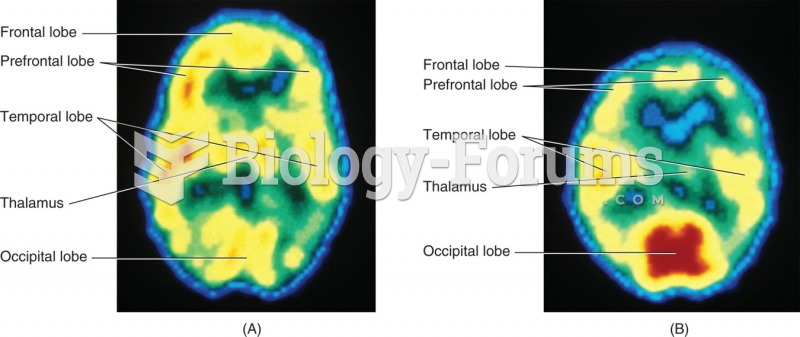 (A) PET scan of a healthy patient. (B) PET scan of a patient with schizophrenia. This patient will ...