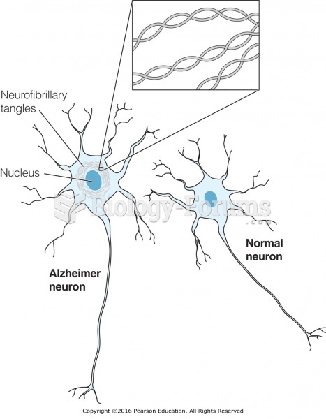 Neuron with neurofibrillary tangles seen in Alzheimer’s disease.