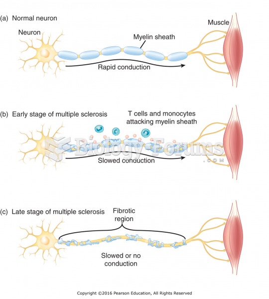 Multiple sclerosis.