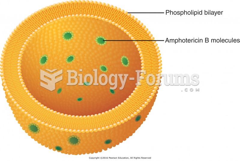 Liposomal amphotericin B: Drug molecules are embedded in the lipid bilayer.