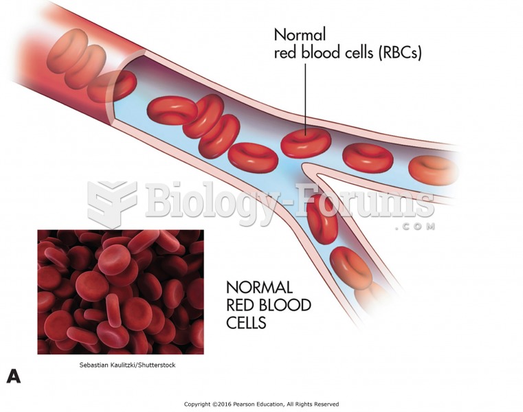 Normal red blood cells (RBCs) are flexible and donut-shaped and move with ease through blood ...