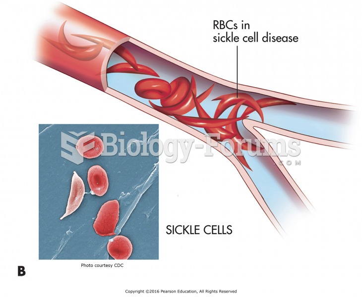 The anatomical distortion of the structure of RBCs in sickle cell anemia affects its normal function ...