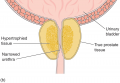 Benign prostatic hyperplasia (BPH): benign prostatic hyperplasia.