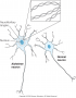 Neuron with neurofibrillary tangles seen in Alzheimer’s disease.