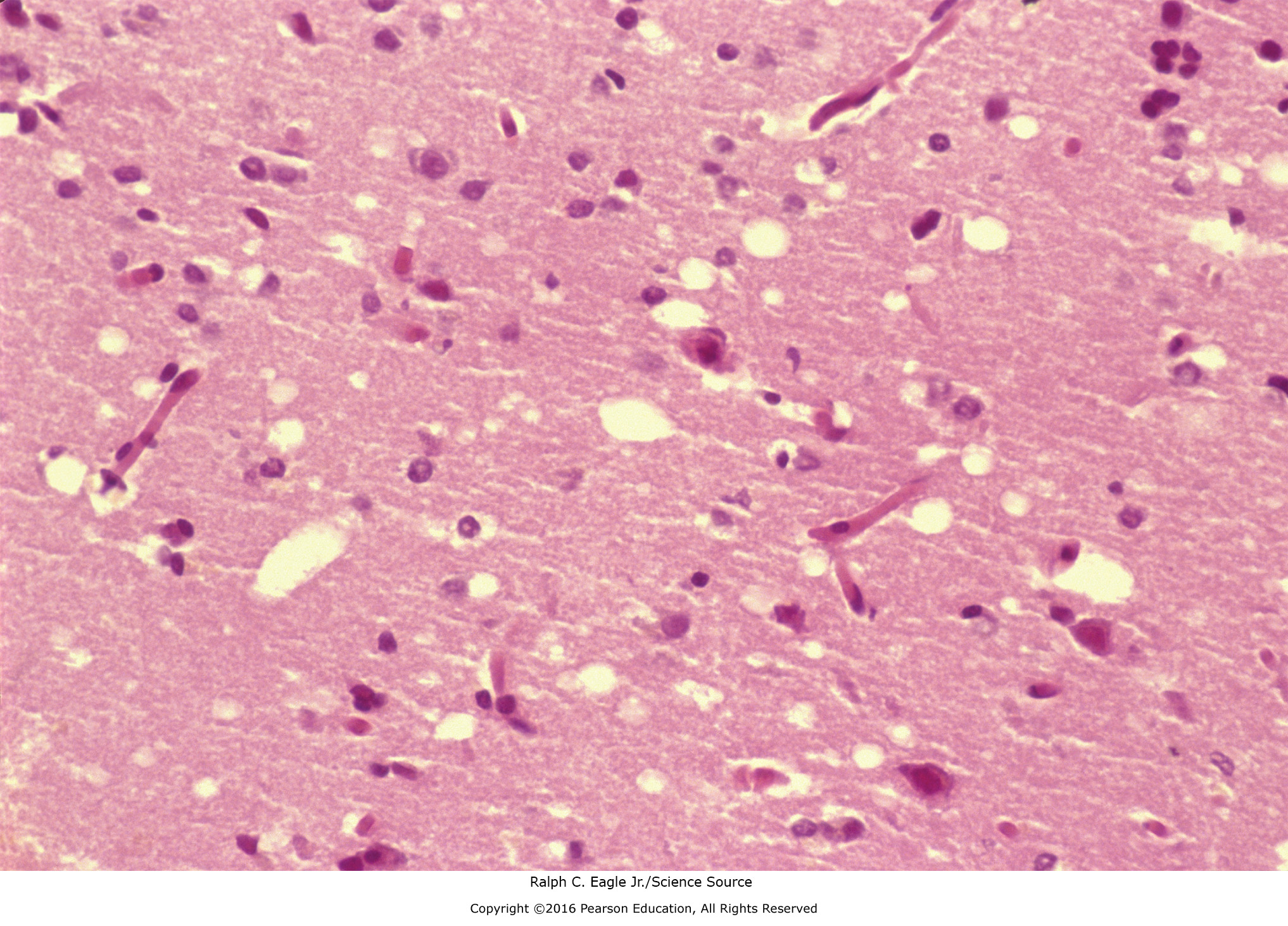 A histologic slide showing the sponge-like architecture of a patient with Creutzfeldt-Jakob Disease.