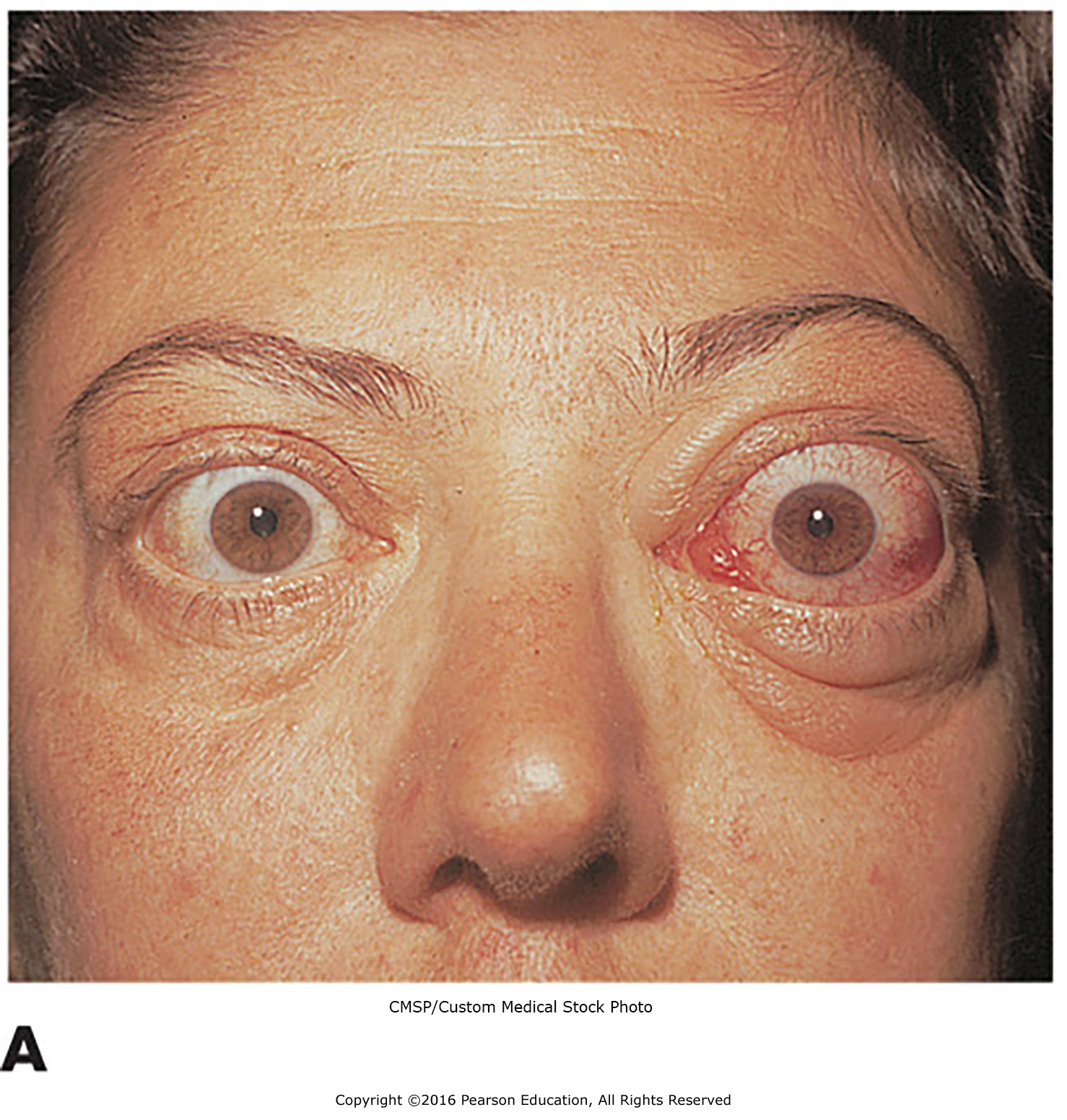 Examples of endocrine disorders. (A) A patient with exophthalmos, a symptom of hyperthyroidism ...