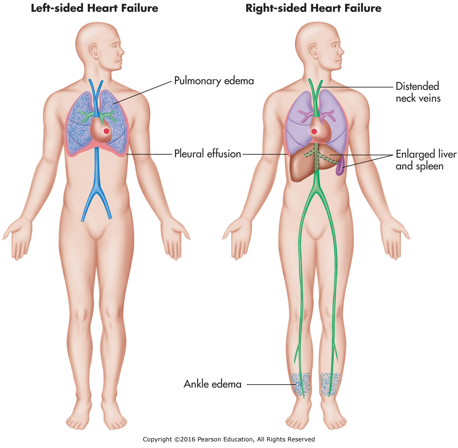 Left-side and right-side heart failure.