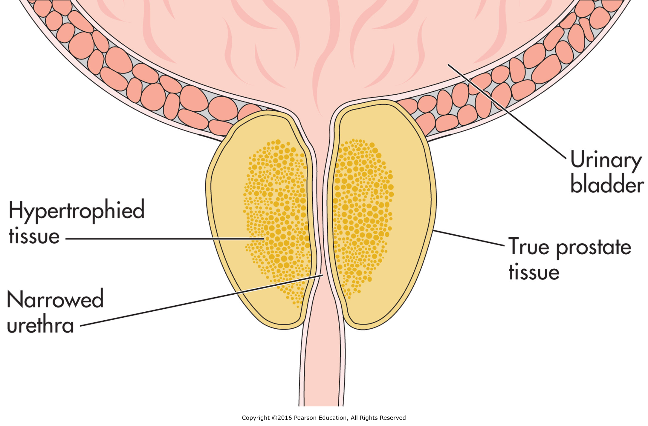 Benign prostatic hyperplasia.