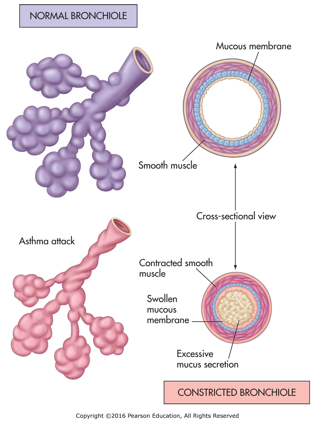 The normal and constricted airway.