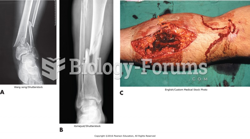 (A) Fibula and tibia communited fracture. (B) Simple, tranverse fracture. (C) Open fracture of the ...