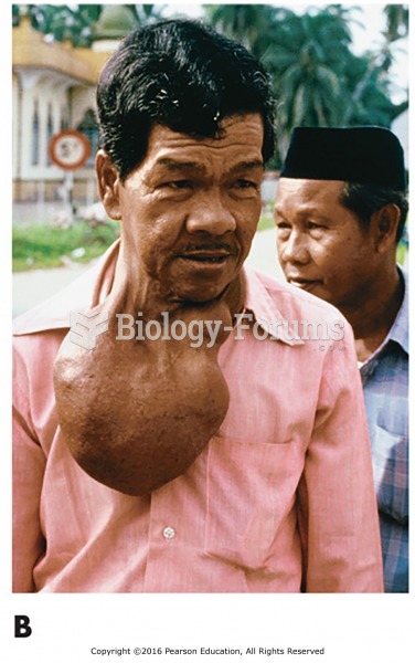 Examples of endocrine disorders. (B) A patient with a goiter.