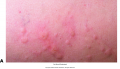 Various types of integumentary conditions.(A) Urticaria (hives).