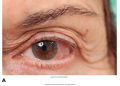 Some common eye disorders. (A) Conjunctivitis (“pinkeye”).