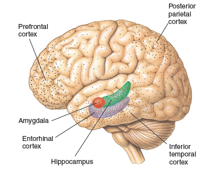 The typical distribution of neurofibrillary tangles and amyloid plaques in the brains of patients ...