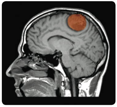 A meningioma.