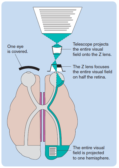 The Z lens, which was developed by Zaidel to study functional asymmetry in split-brain patients. It ...