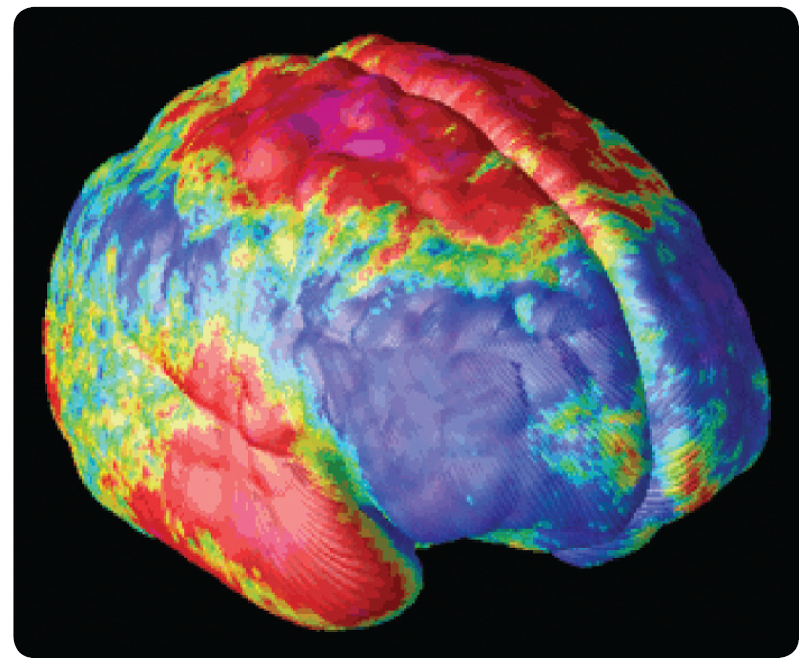 Structural MRIs reveal cortical loss in adolescent patients with schizophrenia. Here dark blue ...