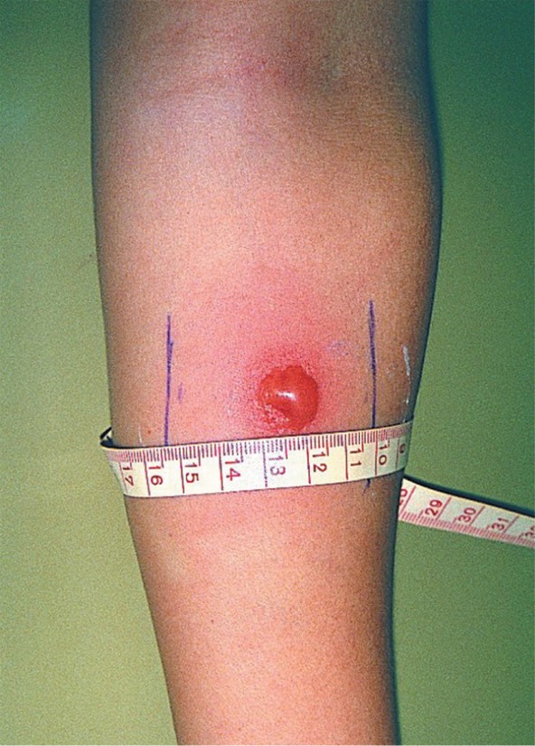 Induration measurement in a tuberculin skin test, a type IV hypersensitivity. 