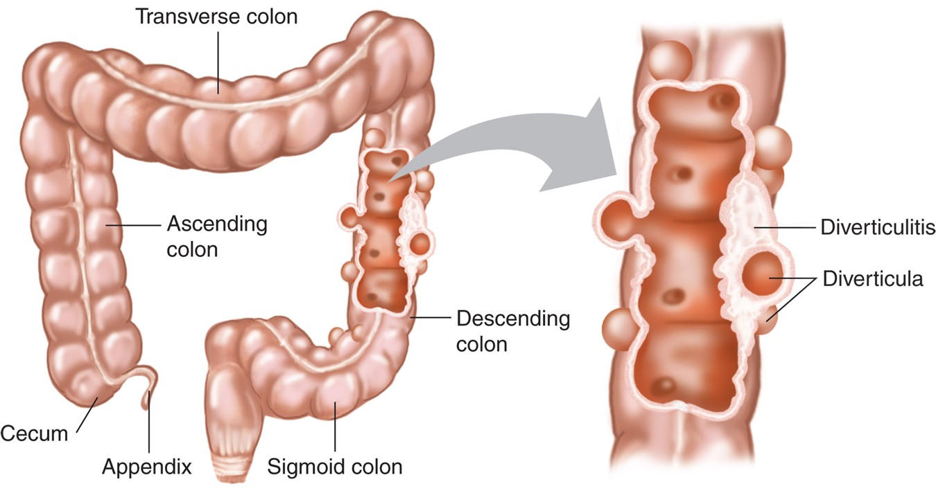 Diverticulitis.