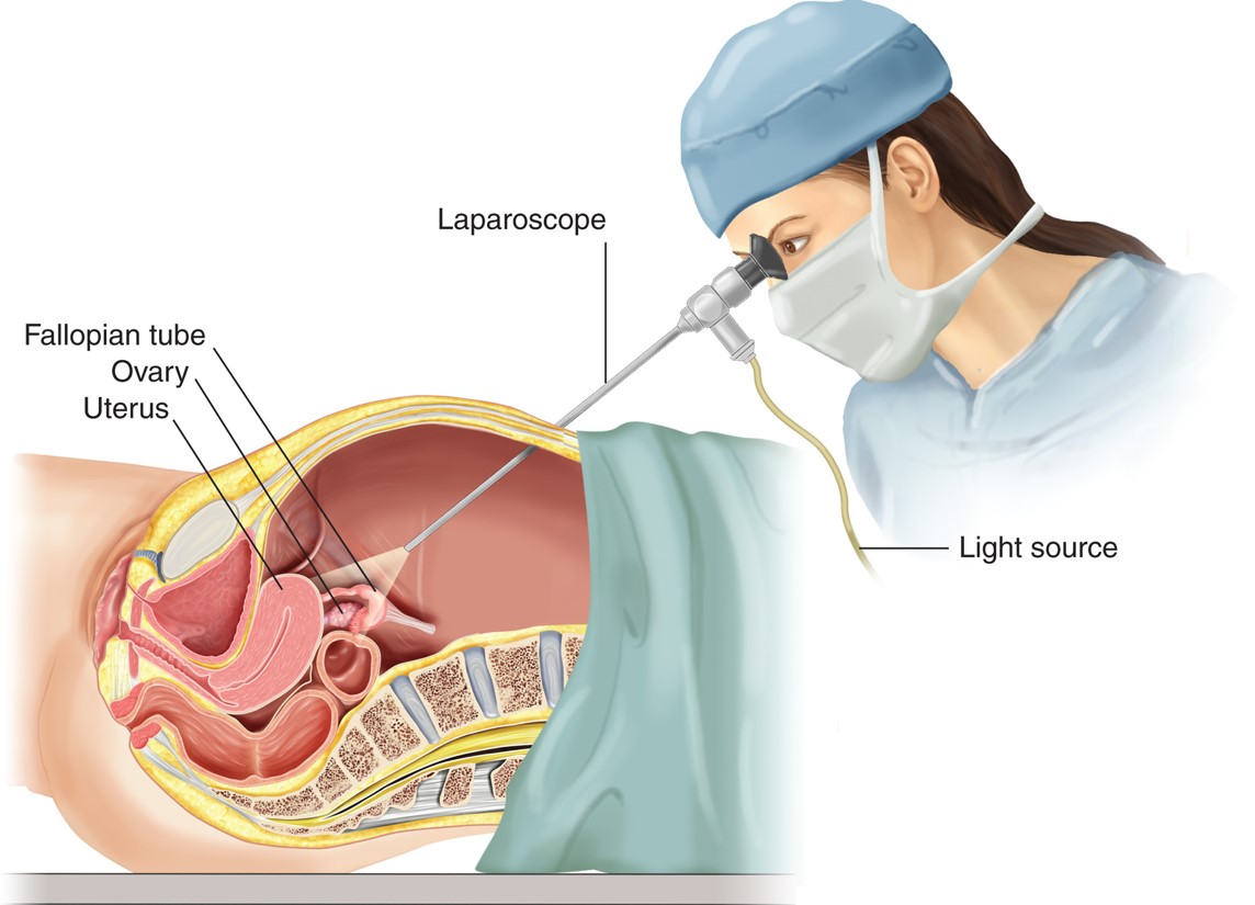 Laparoscopy. A laparoscope is used to view reproductive organs.