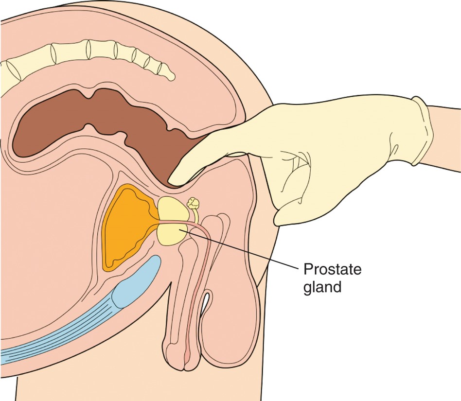 Digital rectal examination to detect abnormalities of the prostate gland.