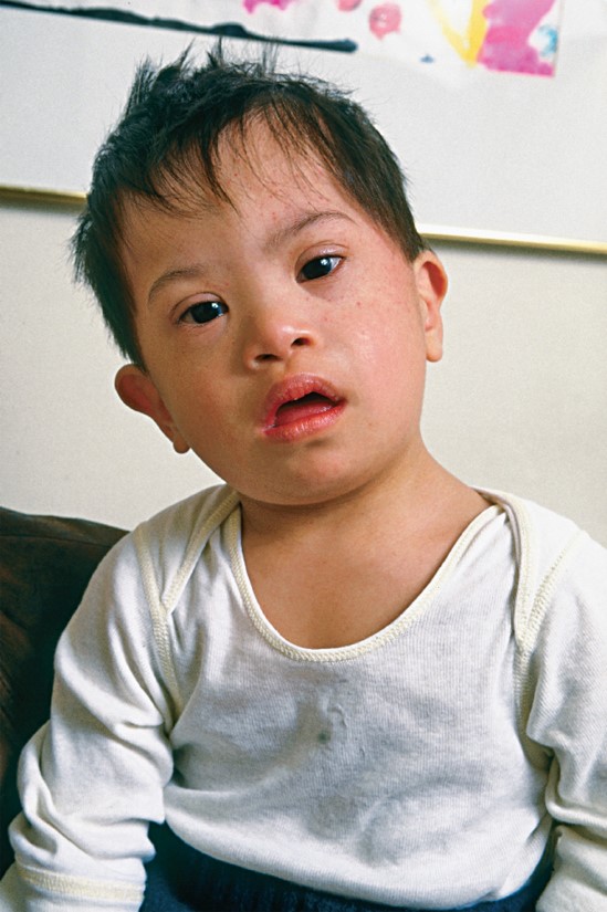Boy with Down syndrome.