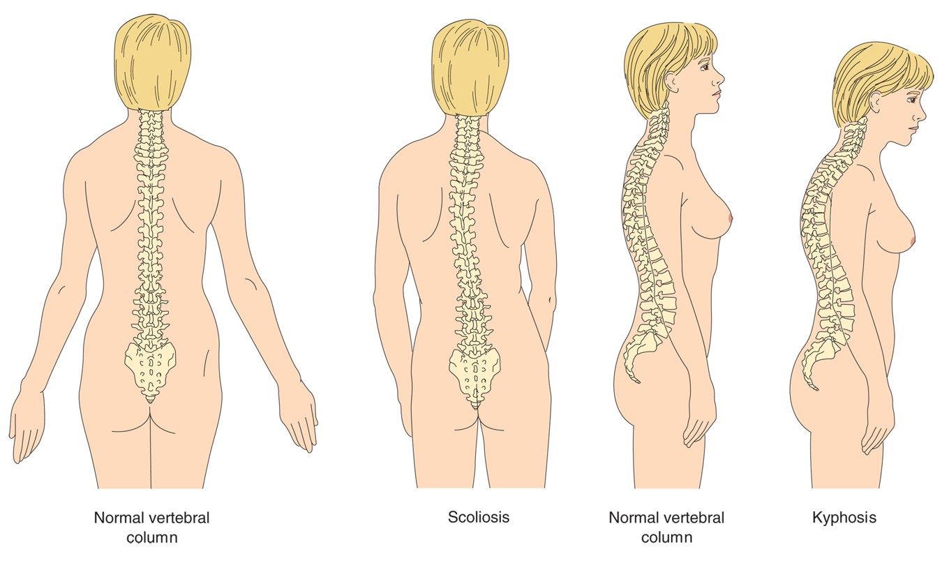 The two most common deformities of the spinal column are scoliosis and kyphosis.