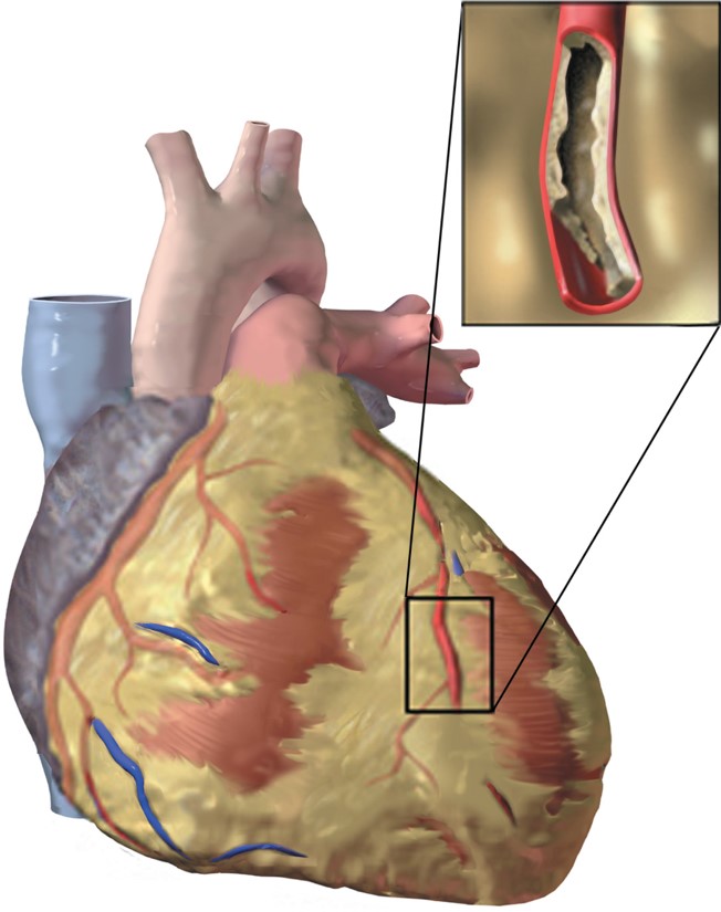 An atherosclerotic artery.