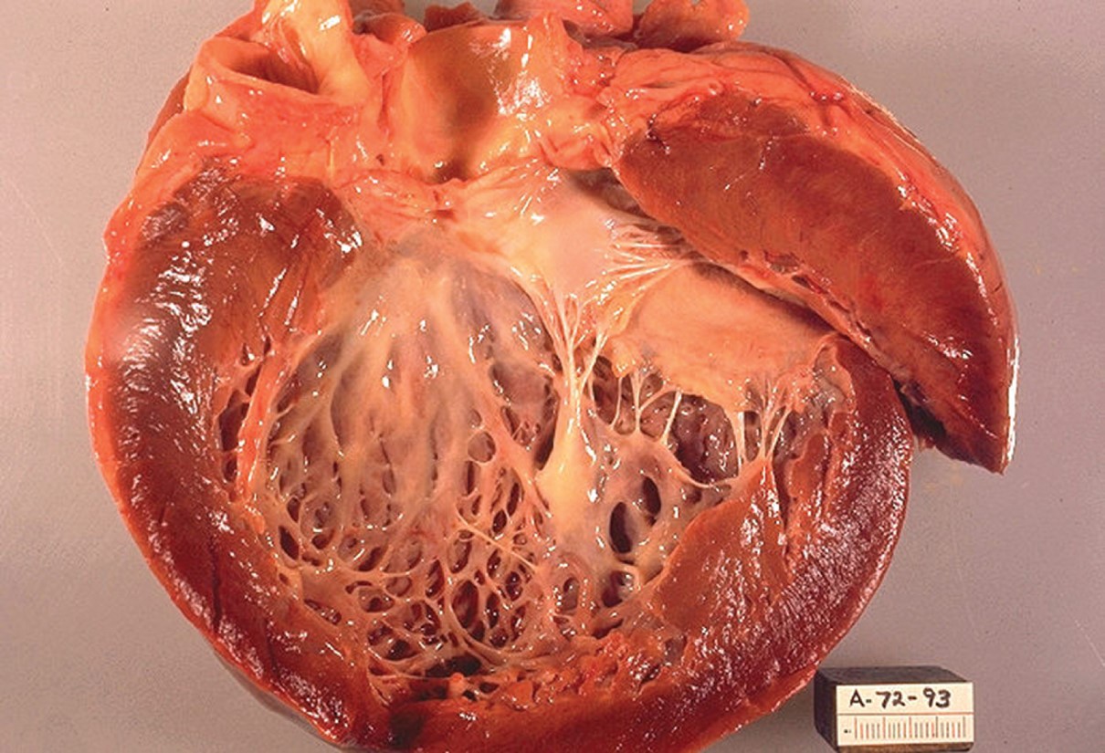 Cardiomyopathy. 