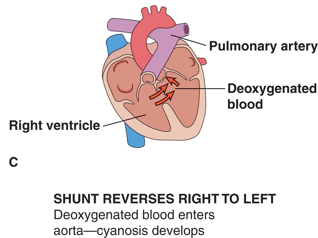 Effects of septal defects: (A) normal shunt; no cyanosis; (B) increased pressure in right ventricle; ...