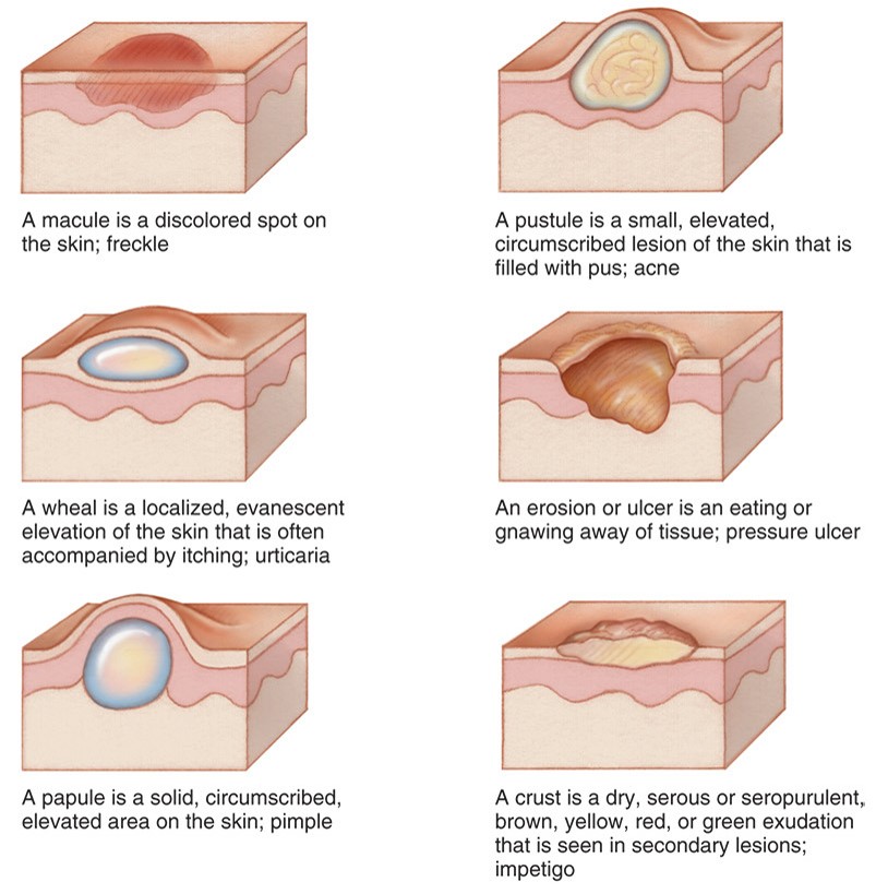 Skin lesions.