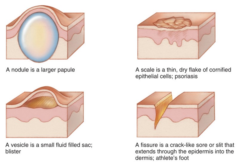 Skin lesions.