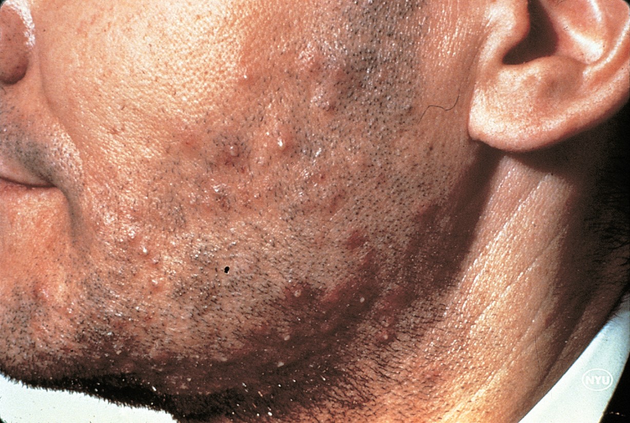 The lesions of folliculitis are pustules surrounded by areas of erythema.