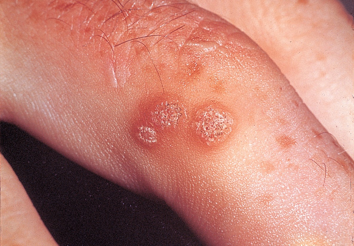 Common warts.