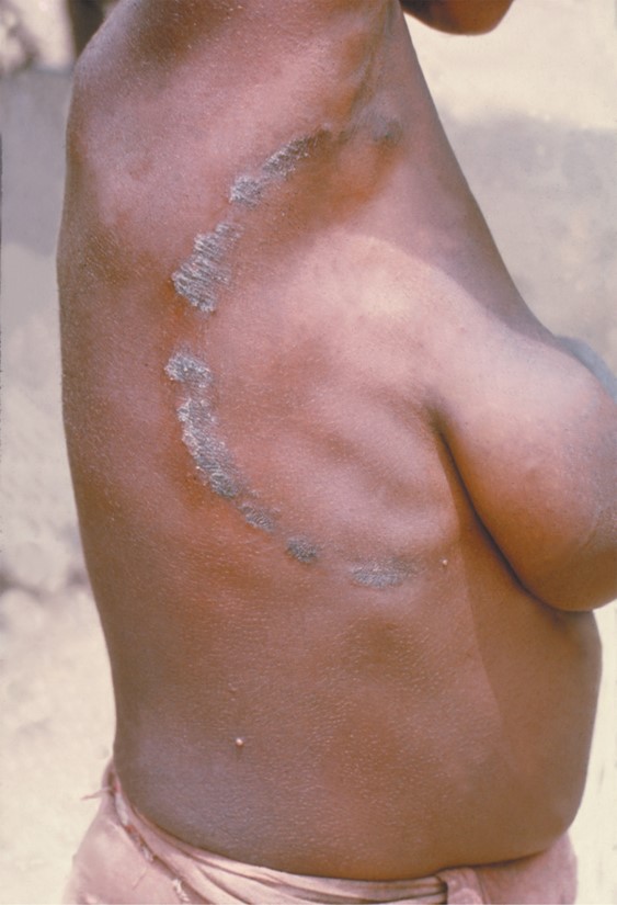 Tinea corporis, or body ringworm.