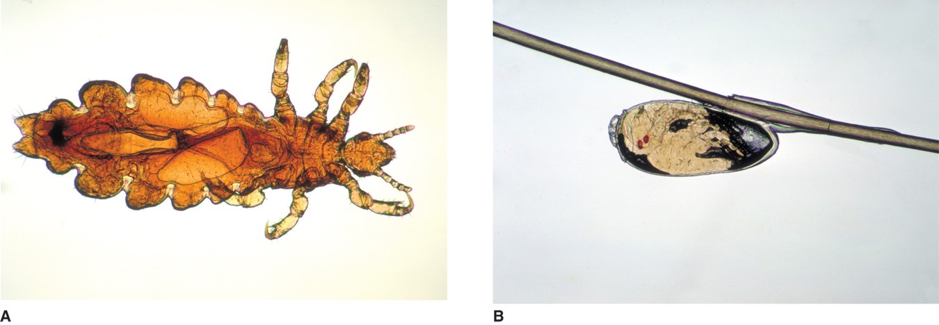 (A) Female head louse. (Courtesy of the Centers for Disease Control and Prevention/ Dr. Dennis ...