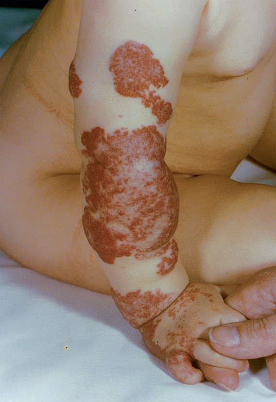 Strawberry hemangioma. 