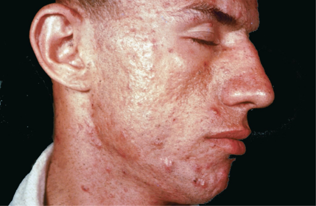 Severe acne. 