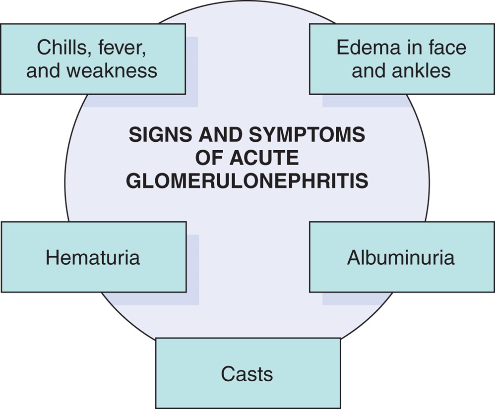 Signs and symptoms of acute glomerulonephritis.