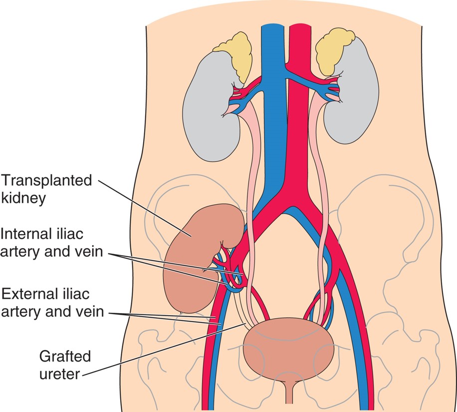 Placement of a transplanted kidney.