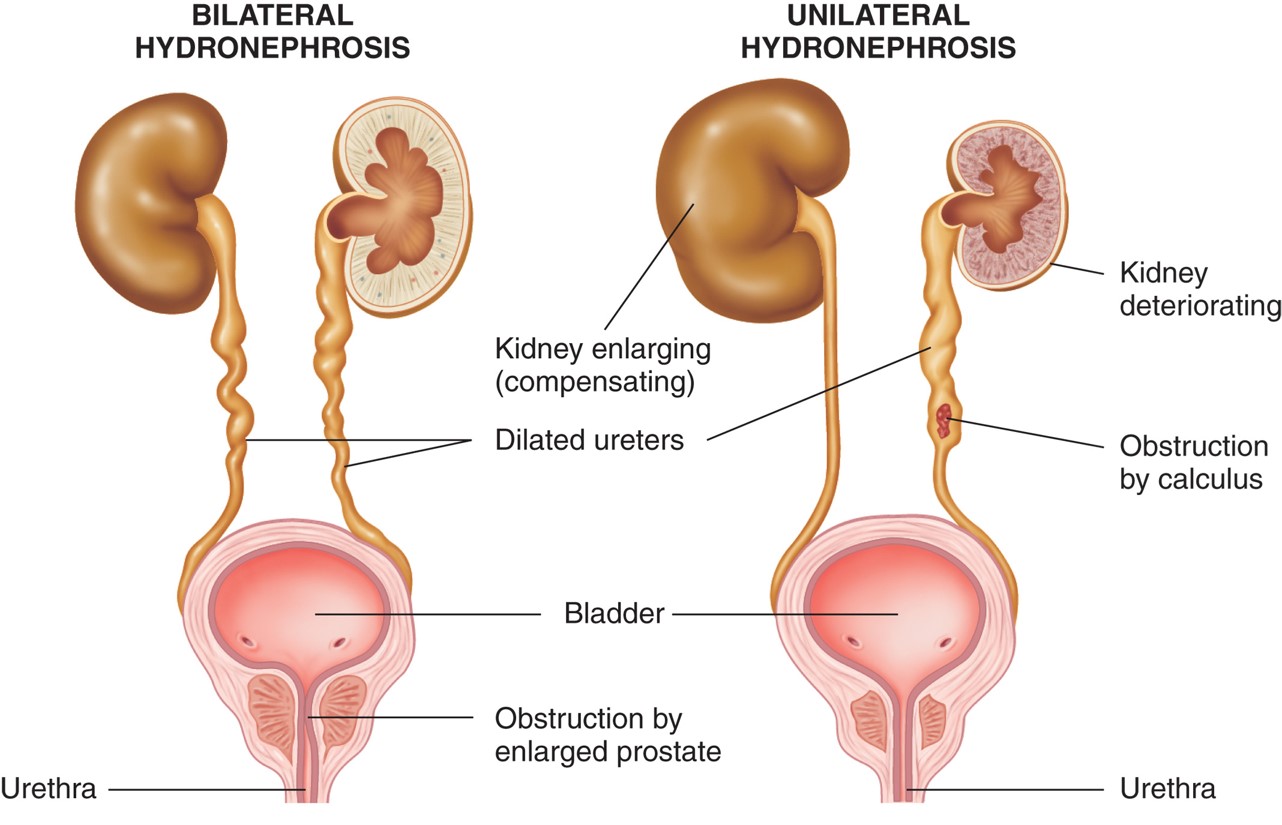 Hydronephrosis: bilateral (left), unilateral (right).