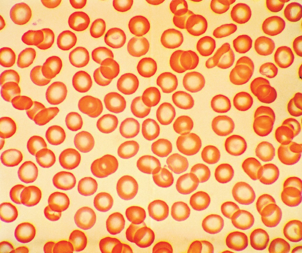 Iron-deficient red blood cells. 