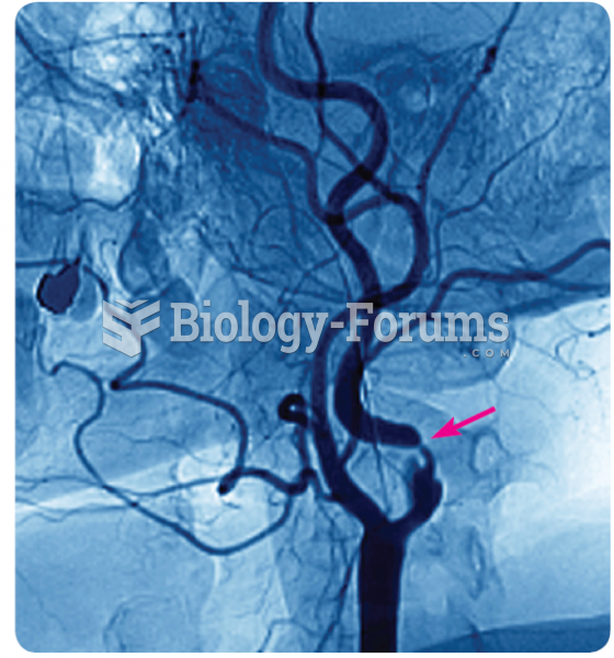 An angiogram that illustrates narrowing of the carotid artery (see arrow), the main pathway of blood ...