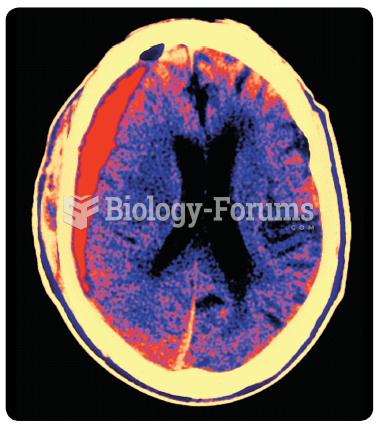 A CT scan of a subdural hematoma. Notice that the subdural hematoma has displaced the left lateral ...