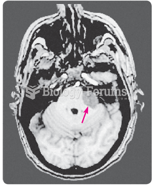 An MRI of Professor P.’s acoustic neuroma. The arrow indicates the tumor.