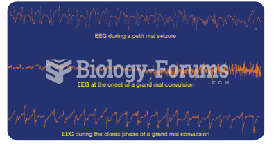 Cortical EEG recorded during epileptic attacks. Notice that each trace is characterized by epileptic ...