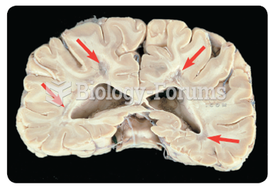 Areas of sclerosis (see arrows) in the white matter of a patient with MS.